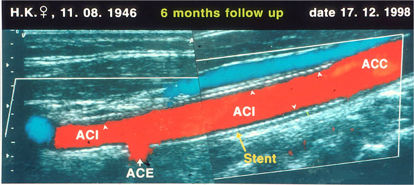 Stent