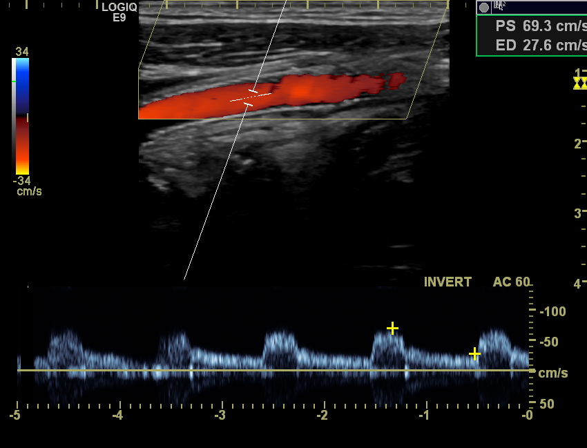 Stent