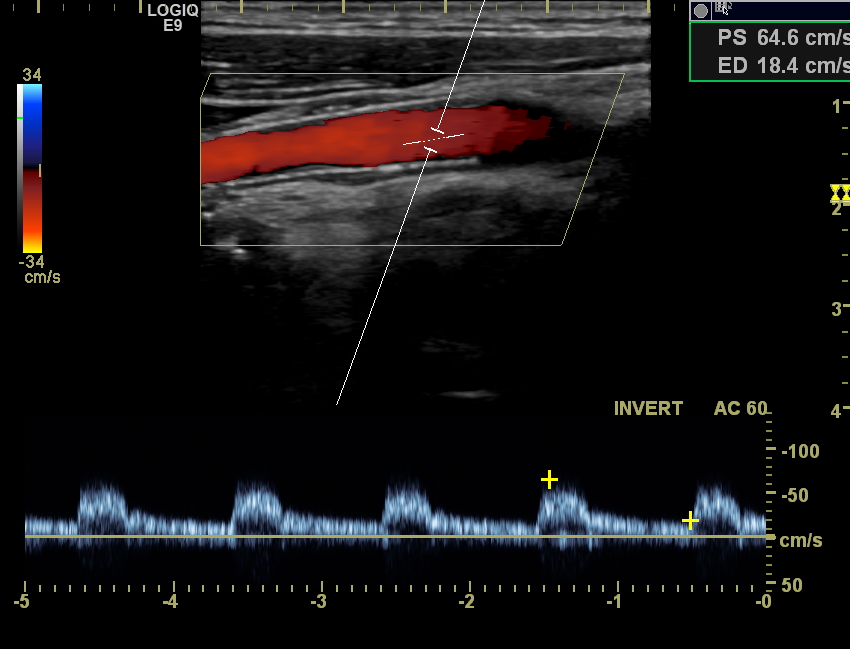 Stent